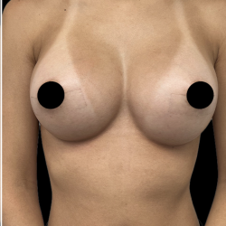 Breast Augmentation Before & After Patient #1639