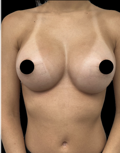 Breast Augmentation Before & After Patient #1639