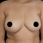 Breast Augmentation Before & After Patient #1640