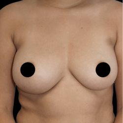 Breast Augmentation Before & After Patient #1640