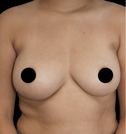 Breast Augmentation Before & After Patient #1640