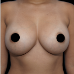 Breast Augmentation Before & After Patient #1640