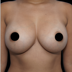 Breast Augmentation Before & After Patient #1640