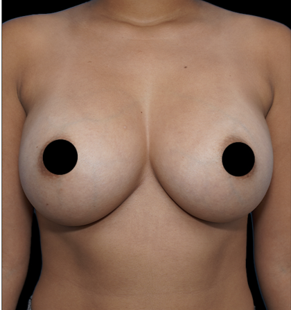Breast Augmentation Before & After Patient #1640
