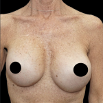 Breast Augmentation Before & After Patient #1641