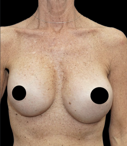 Breast Augmentation Before & After Patient #1641
