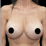 Breast Augmentation Before & After Patient #1641