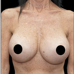 Breast Augmentation Before & After Patient #1641