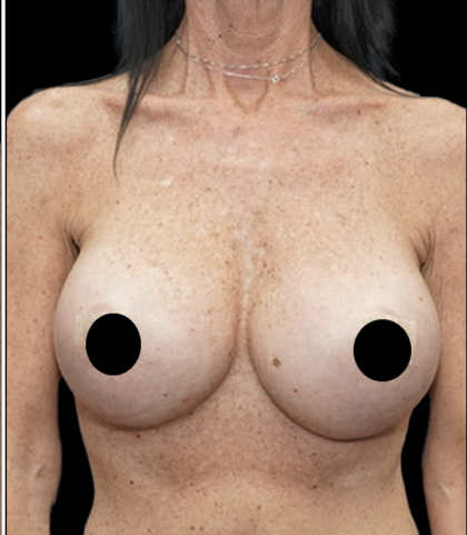 Breast Augmentation Before & After Patient #1641
