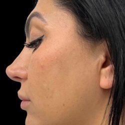 Chin Liposuction Before & After Patient #1561