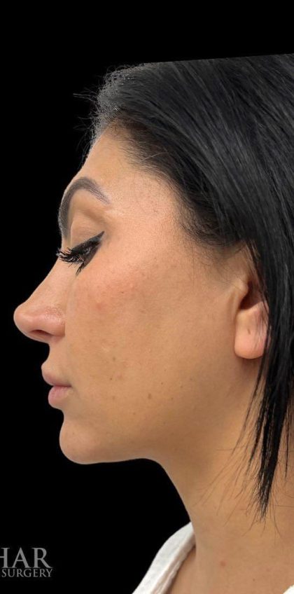 Chin Liposuction Before & After Patient #1561