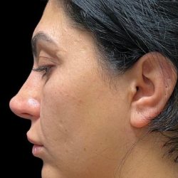 Chin Liposuction Before & After Patient #1561