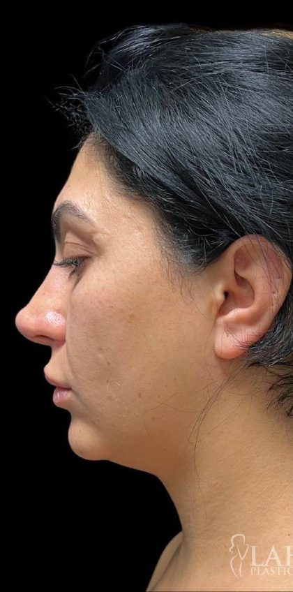 Chin Liposuction Before & After Patient #1561