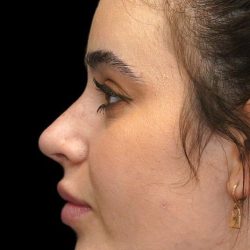 Chin Liposuction Before & After Patient #1579