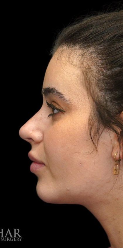 Chin Liposuction Before & After Patient #1579