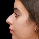 Chin Liposuction Before & After Patient #1579