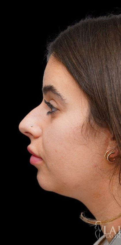 Chin Liposuction Before & After Patient #1579