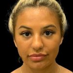 Chin Liposuction Before & After Patient #1759