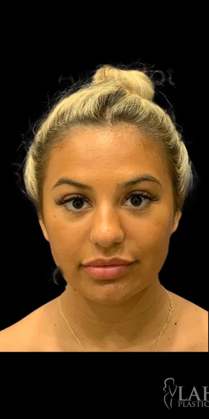 Chin Liposuction Before & After Patient #1759