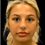 Chin Liposuction Before & After Patient #1759