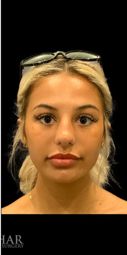 Chin Liposuction Before & After Patient #1759