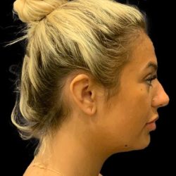 Chin Liposuction Before & After Patient #1759