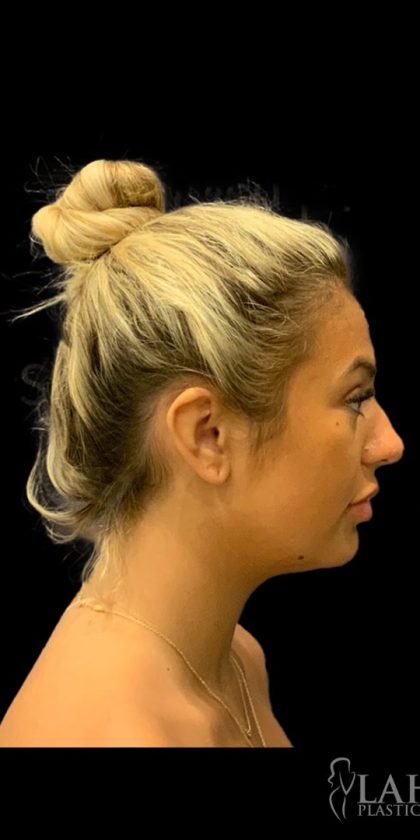Chin Liposuction Before & After Patient #1759