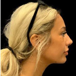 Chin Liposuction Before & After Patient #1759
