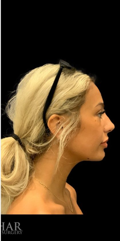 Chin Liposuction Before & After Patient #1759