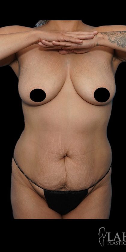 Tummy Tuck Before & After Patient #1746