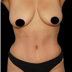 Tummy Tuck Before & After Patient #1746