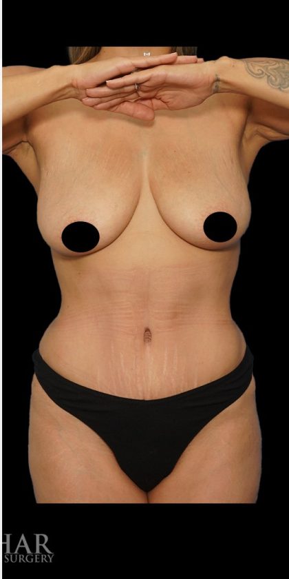 Tummy Tuck Before & After Patient #1746