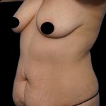 Tummy Tuck Before & After Patient #1746