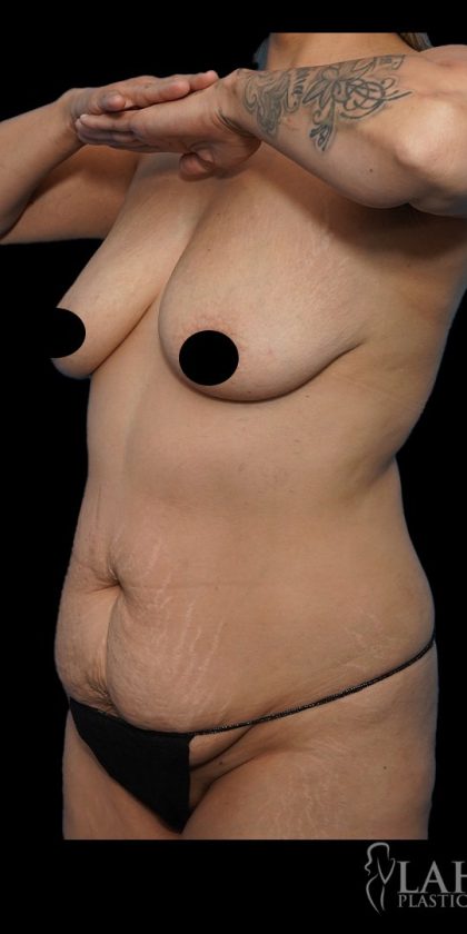 Tummy Tuck Before & After Patient #1746
