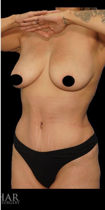 Tummy Tuck Before & After Patient #1746