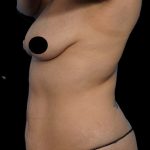 Tummy Tuck Before & After Patient #1746